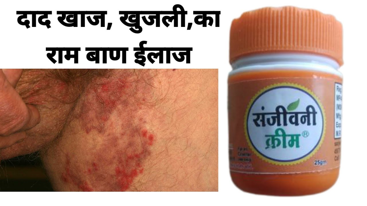 Daad ,khaaj, khujli (fungle infection ) ka ram baan ilaj sanjeevni