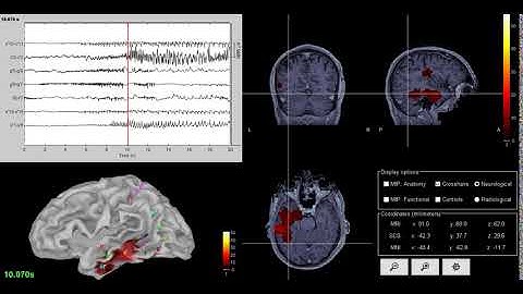 Brainstorm SEEG tutorial: epileptogenicity maps