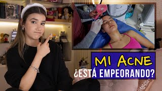 El TRATAMIENTO que me DESTRUYÓ la CARA | Ana Emilia