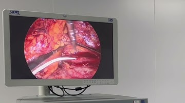 MỔ NỘI SOI LẤY SỎI NIỆU QUẢN | BÁC SĨ TÙNG SỎI THẬN