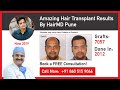 Amazing hair transplant results by hairmd pune  hairmd pune