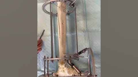 Circular External Fixation Frame Configuration Tibial/Foot Support (Dr. Edgardo Rodriguez-Collazo)