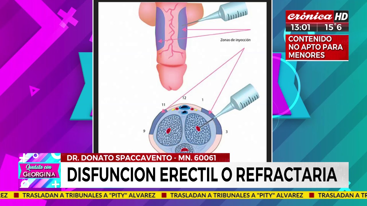 disfunción eréctil y hernia l4 l5