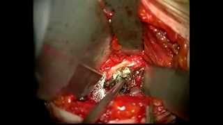 cervical listhesis surgery cervical listhesis surgery