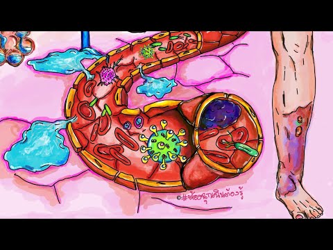 Sepsis ติดเชื้อในกระแสเลือด