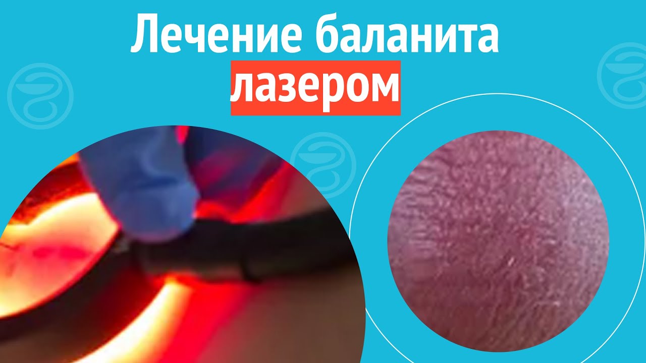 ✅ Лечение баланита лазером. Клинический случай №1135