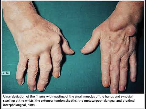 case study of patient with rheumatoid arthritis