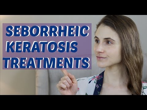 SEBORRHEIC KERATOSIS TREATMENTS (INCLUDING ESKATA)| DR DRAY
