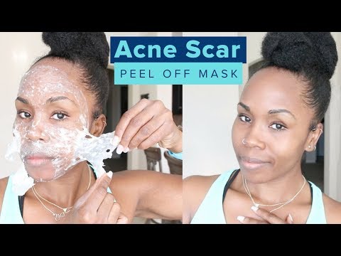 Acne Scar Removal Skincare Peel | Remove Dead Skin, Oily Skin, Skin Pigmentation & Blackheads