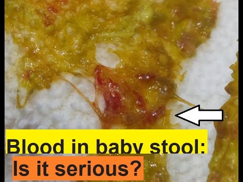 Blood in baby stool: Is it serious?