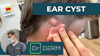 Ear Cyst | Dr. Derm