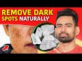 How to Remove Dark Spots and Get Clear Skin? (Pigmentation, Dark Underarms, Acne scars &amp; more)