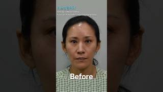 리프팅+지방이식/흡입만으로 이렇게 달라진다고?!안면거상 하안검 이마거상 수술 전후비교!#리프성형외과 #안면거상 #내시경이마거상 #지방흡입 #지방이식 #수술전후 #안면거상술후기