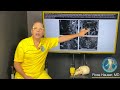 Spinal cord tension and cervical dysstructure: MRI, CT, and symptom discussion with Ross Hauser, MD