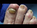 What causes thick toenails?  The Baker and her Thick Toenails and Callus Trimming