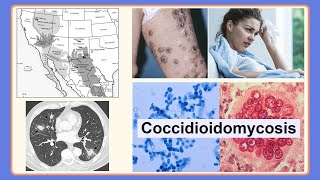 coccidioidomycosis