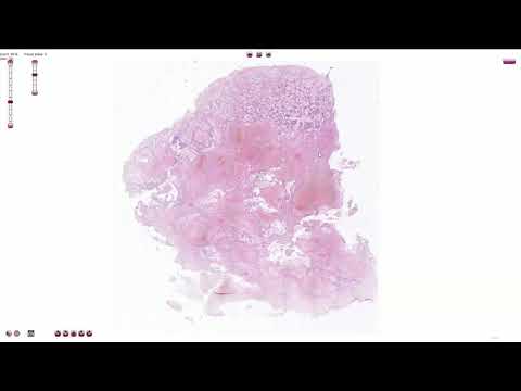 Choriocarcinoma - Histopathology