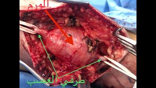 استئصال ورم بعصب الساق  Excision of Sural nerve Schwannoma