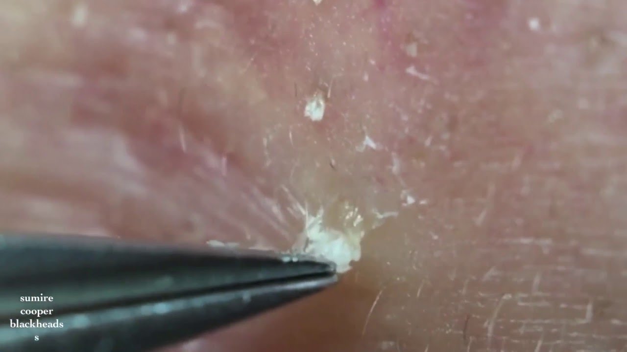 鼻角栓66.2!!! nose blackheads（Larger version）★Tweezers only★ YouTube