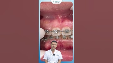 Buộc Chỉ Thép Cố Định Trong Niềng Răng | Bác Sĩ Yên