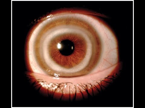 Interstitielle Keratitis beim Cogan Syndrom