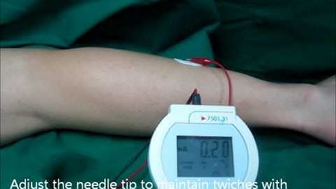 Parasacral Sciatic Nerve Block (Mansor tecnique) using nerve stimulation.wmv