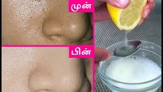 முகத்தில் உள்ள சிறு-சிறு குழிகள் மறைய| Open Pores Tips In Tamil|  Tamil Beauty Tips