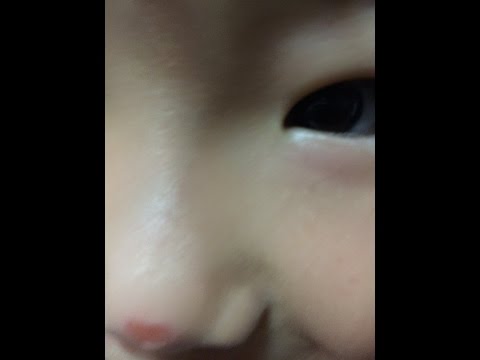 「無残」娘が火傷。なぜこんな所に。