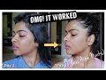 My Acne Scars were GONE (with PROOF) using this Product | 2 Week Challenge | Shalini Mandal