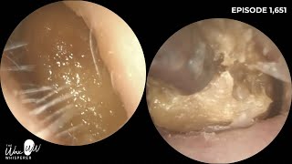 1,651 - 4 Monthly Ear Wax Removal