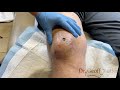 Drainage of a knee hematoma