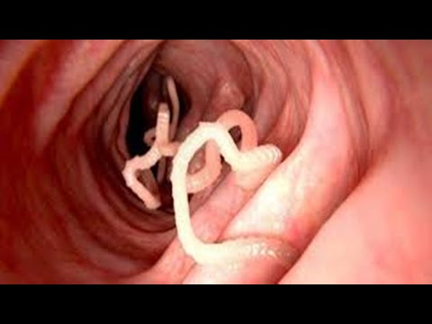 ✅  9 Sintomas que podem indicar que você está vermes intestinais!