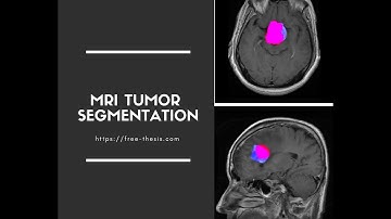 Brain MRI Tumor Segmentation in MATLAB