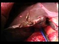 Transekcija parenhima jetre  clamp crushing   hirurgija jetre