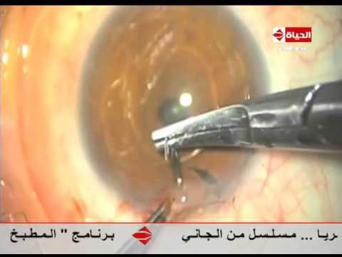 برنامج العيادة د إيهاب سعد عثمان أنواع عدسات العين  