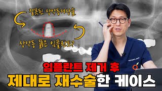 상악동 뚫고 들어간 임플란트? 🤦‍♂️ 잘못된 임플란트 제거 후 제대로 재수술!