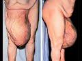 Old man with huge Hernia
