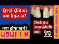 दांत हिलते हों तो क्या करें  ??MOBILE TEETH -its solutions-जाने क्या होगा खर्च ?? -Dr.Praveen Bhatia