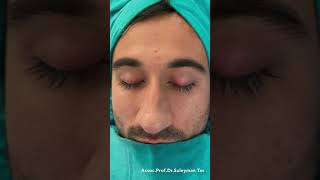 Thick Skinned Male Rhinoplasty | Before and After