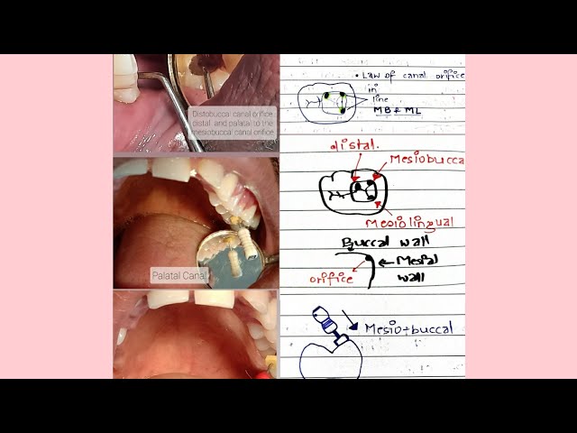 Locating CANAL ORIFICES was never this EASY!! Mandibular and Maxillary first Molar!! class=