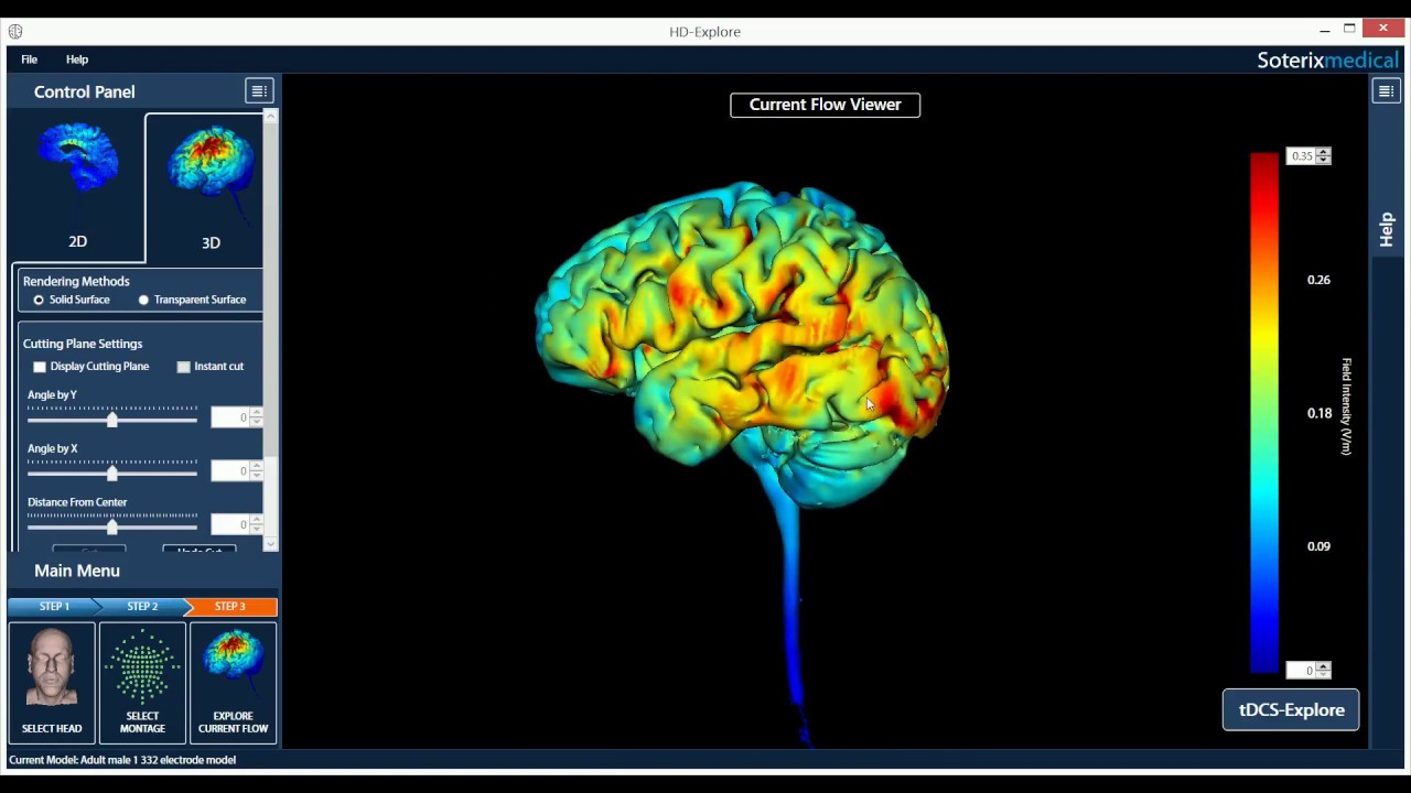 Aphasia patients experience improvement in language processing after tDCS treatments.