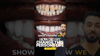 How Dr. Josh changed this persons life with composite bonding 🤯😍 #veneers #viral