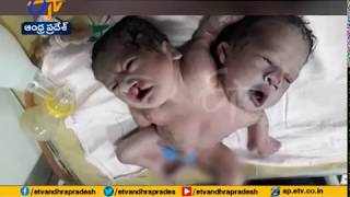 Woman in Madhya Pradesh Gives Birth to Boy with 2 Heads, 3 Hands