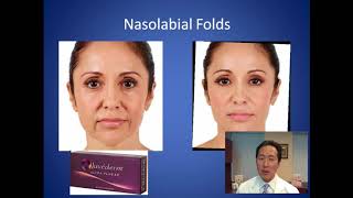What's the Best Filler for Smile Lines  Nasolabial Folds Consultation  Dr. Anthony Youn