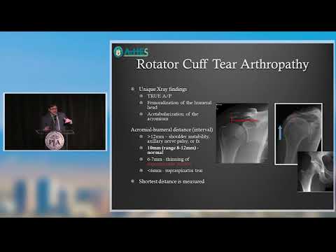 PAOS Pearl: Rotator Cuff Arthropathy