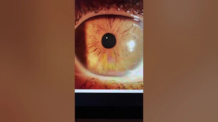 Incidious steroid-related IOP spike post LASIK mas...