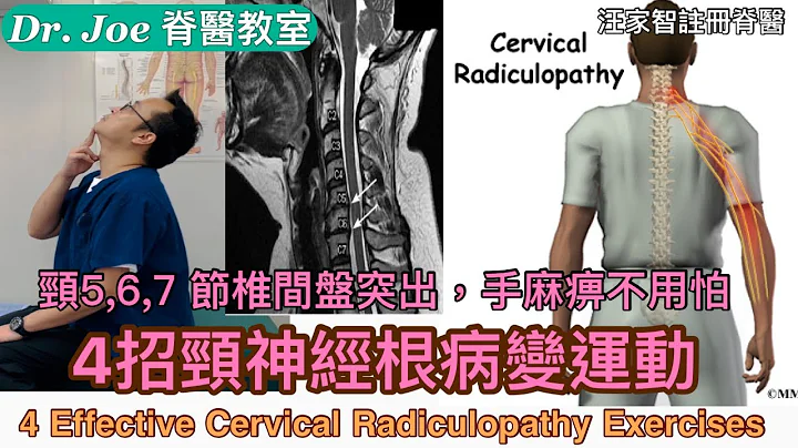 頸5,6,7,節椎間盤突出症、手麻痹⋯⋯怎樣辦？教大家4 招頸神經根病變運動！[Eng Subtitles] 4 Effective Cervical Radiculopathy Exercises - 天天要聞