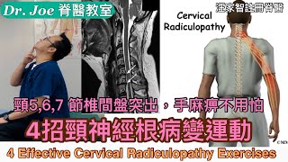 頸5,6,7,節椎間盤突出症、手麻痹⋯⋯怎樣辦？教大家4 招頸神經根病變運動！[Eng Subtitles] 4 Effective Cervical Radiculopathy Exercises