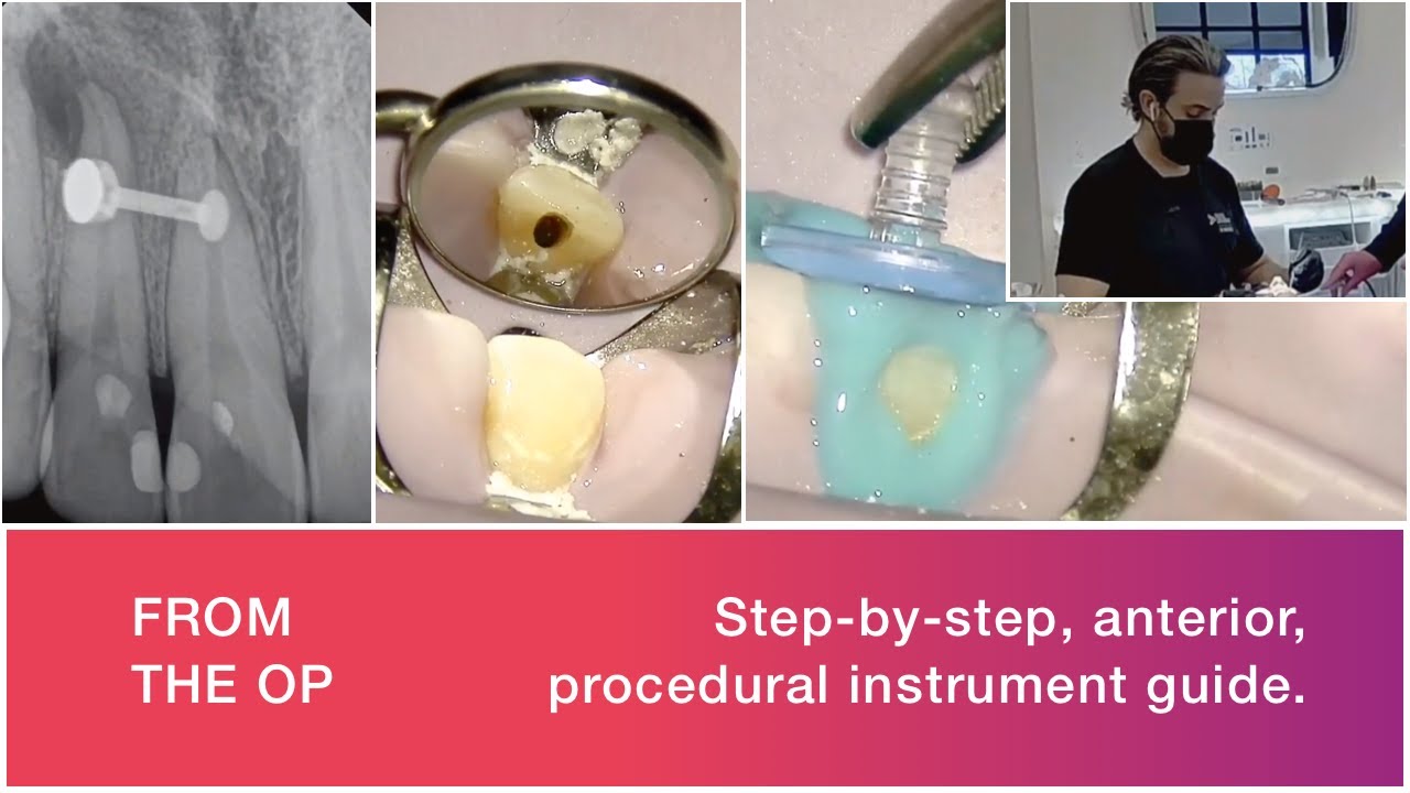 LIVE GentleWave Procedure Anterior Tooth YouTube