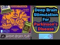 Deep Brain Stimulation for Parkinson&#39;s Disease